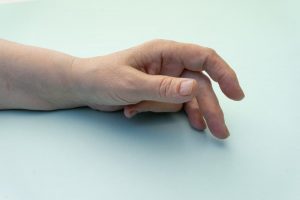Dupuytren’s contracture