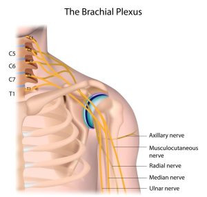 Long Term Disability Lawyers for Brachial Plexus Injuries