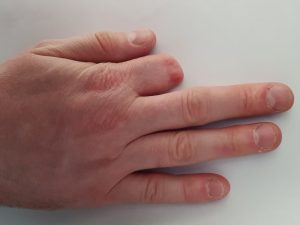 hand with missing finger